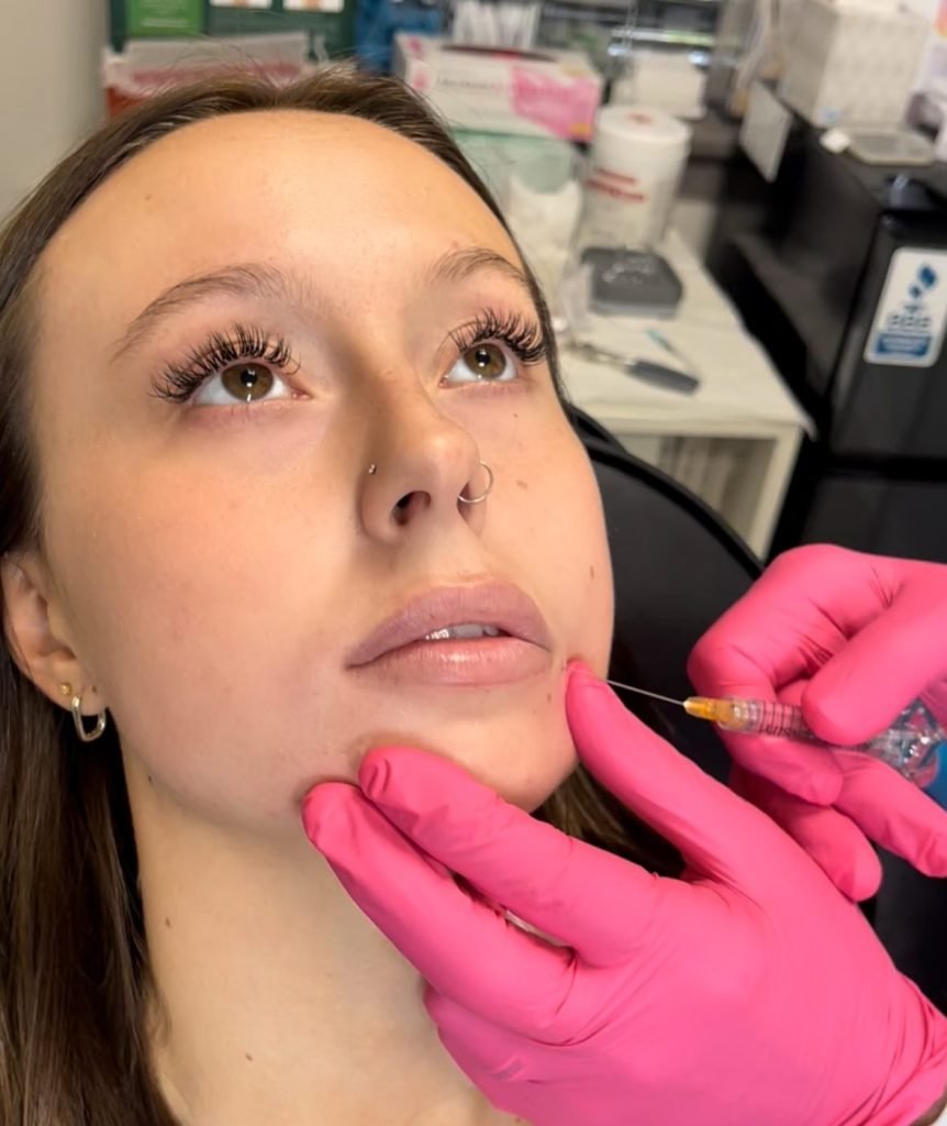 Lip Filler in Burnsville