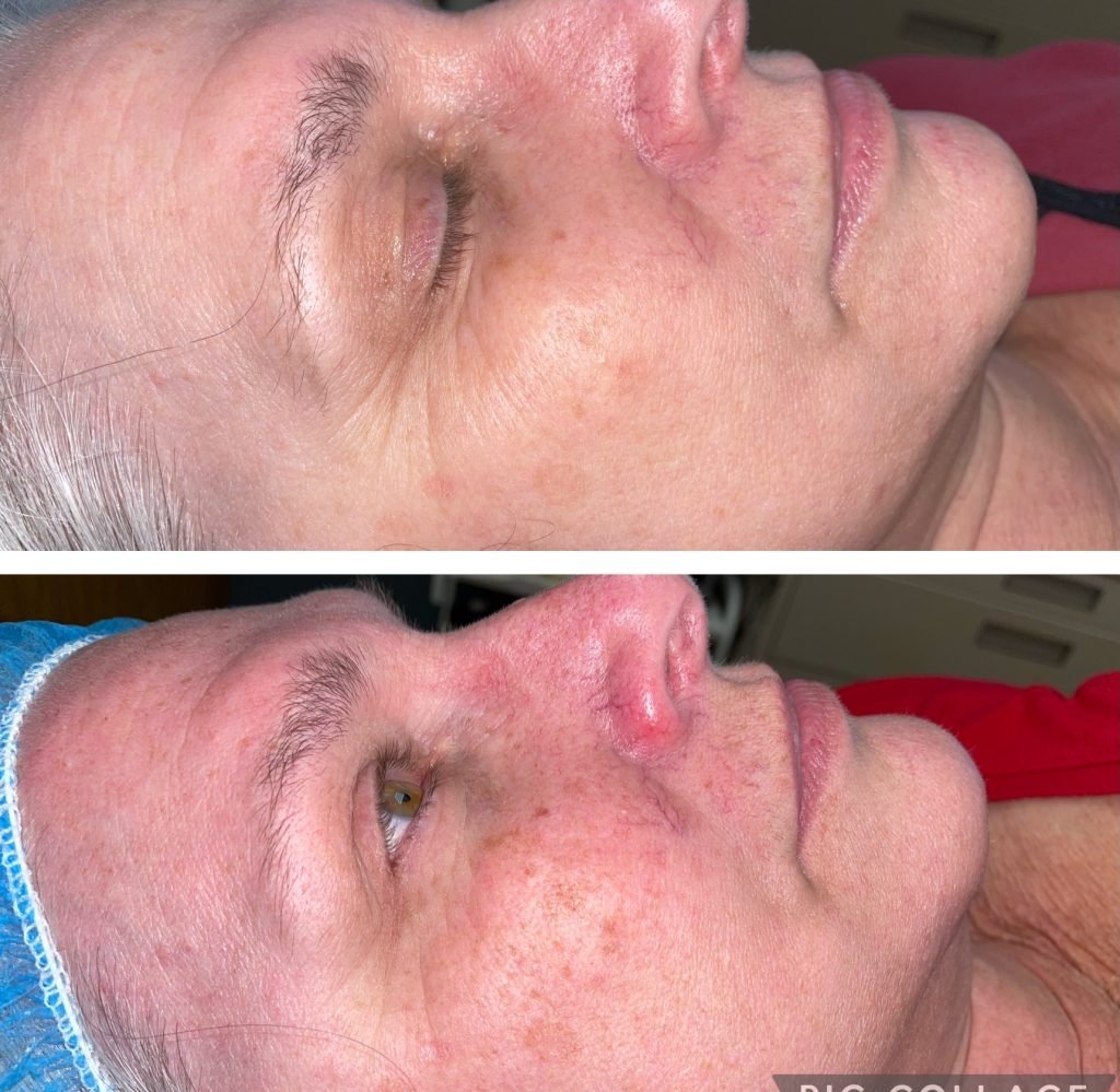 IPL Facial burnsville