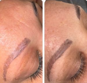 Saline Tattoo Removal
