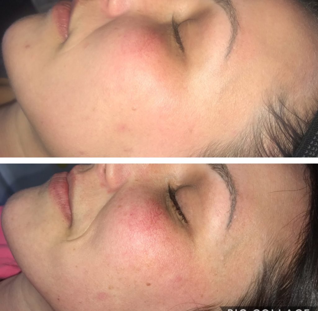 IPL Facial Burnsville