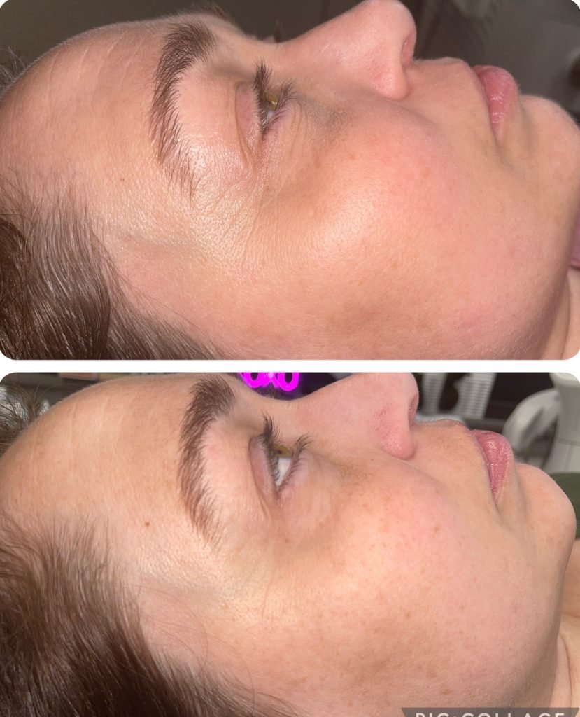 IPL Facial Burnsville