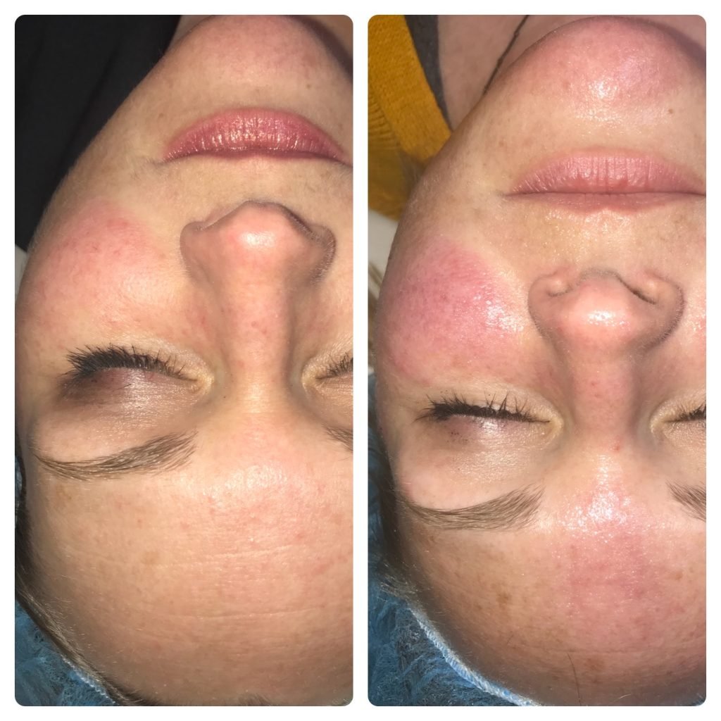 IPL Facial Burnsville