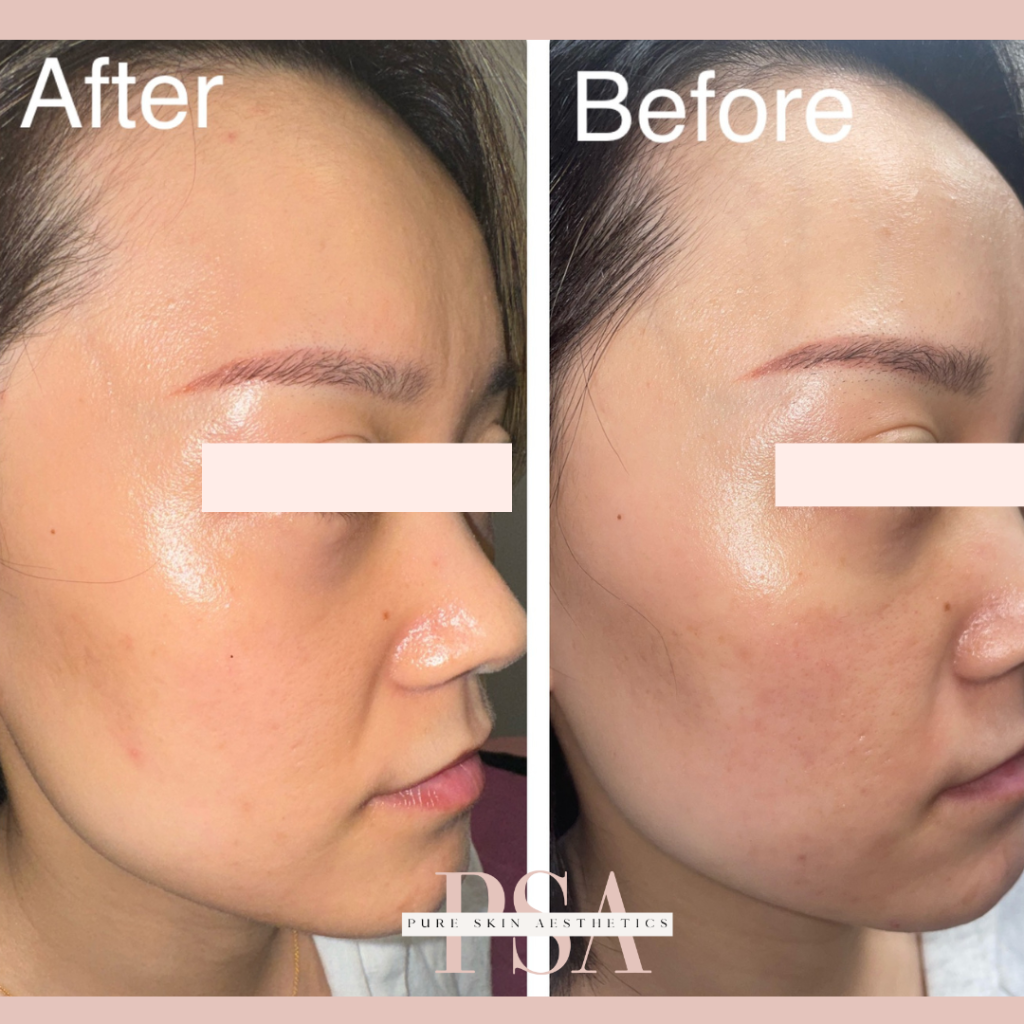 Tixel treatment burnsville
