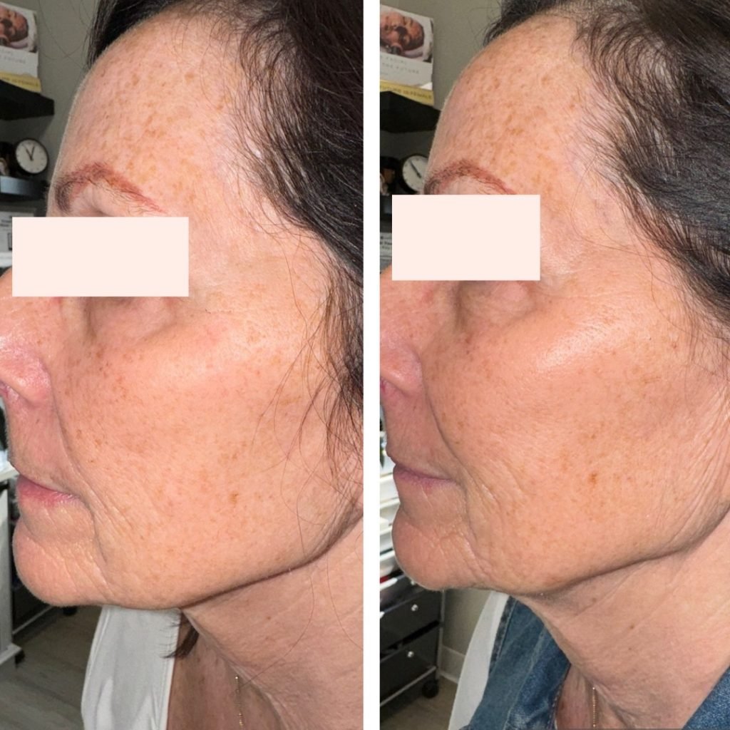Tixel treatment in Burnsville, MN
