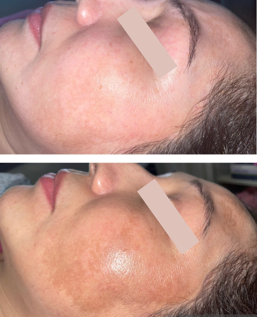 melasma treatment burnsville