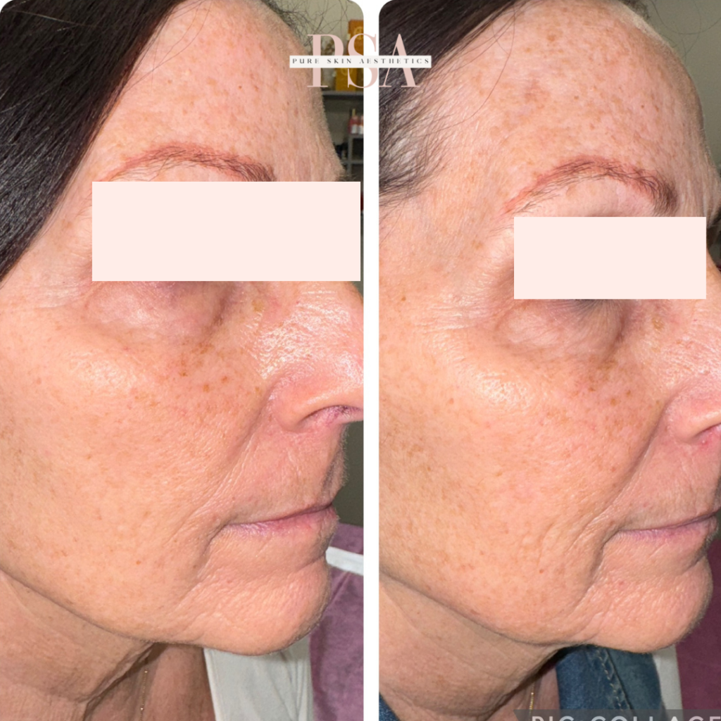 tixel skin tightening burnsville