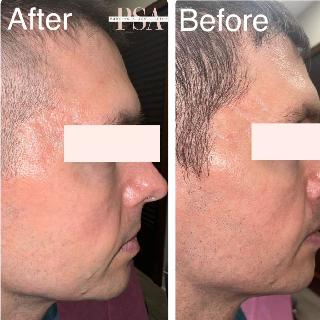tixel skin rejuvenation burnsville