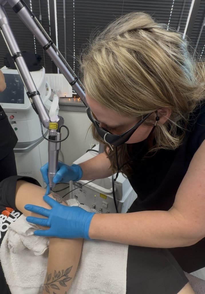 laser tattoo removal in savage