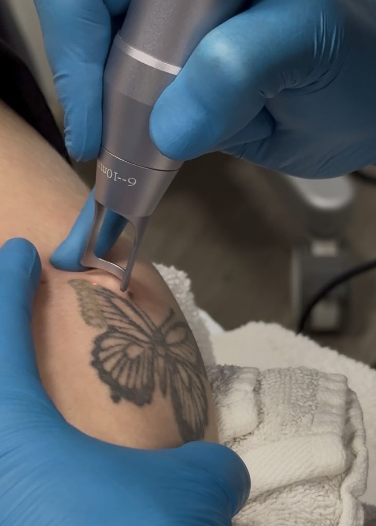 laser tattoo removal prior lake mn