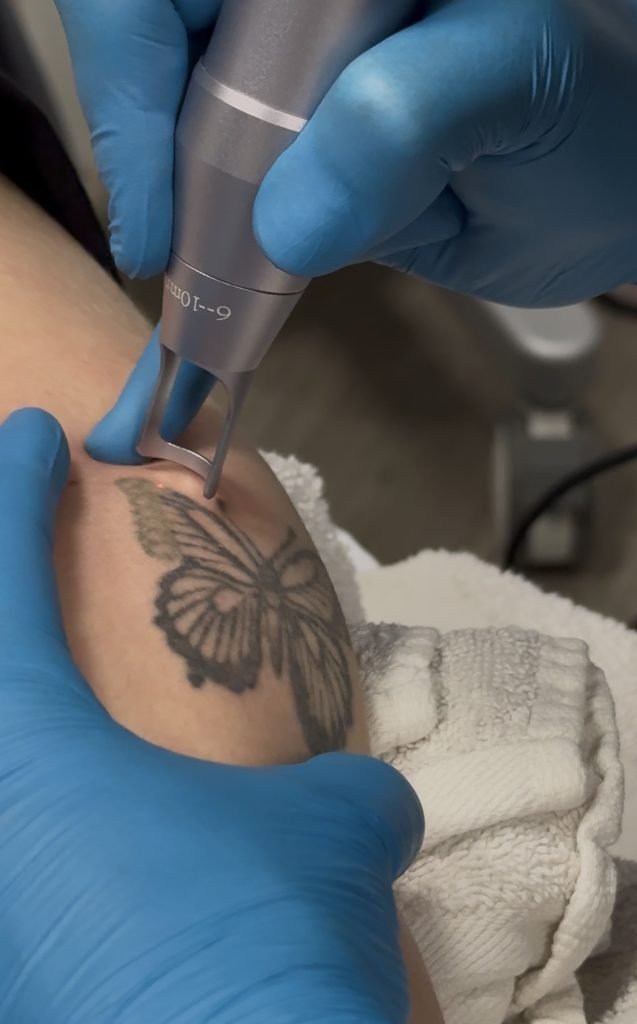 laser tattoo removal bloomington mn