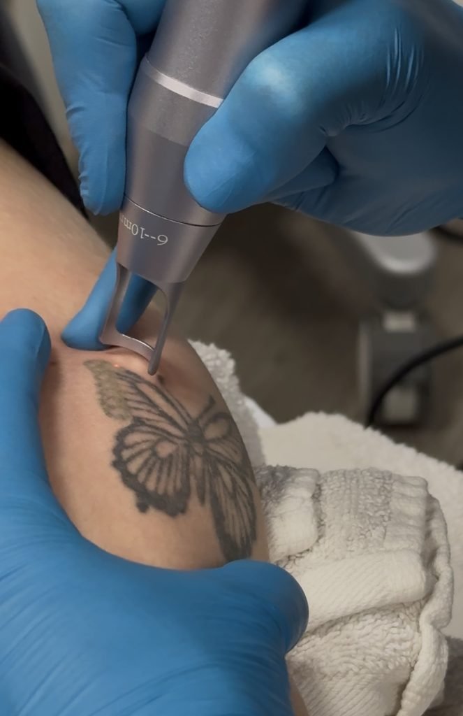 laser tattoo removal in savage
