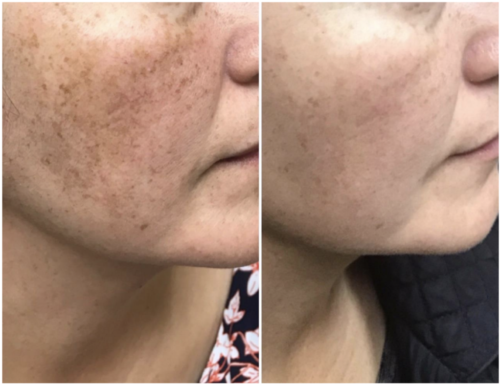 laser pigment correction treatment burnsville mn