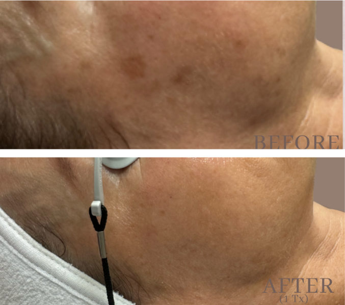 pico laser facial prior lake mn