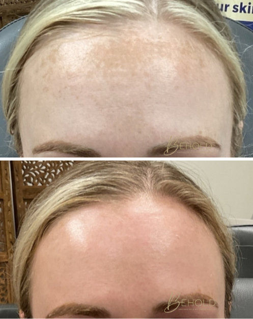 picolazer facial shakopee mn