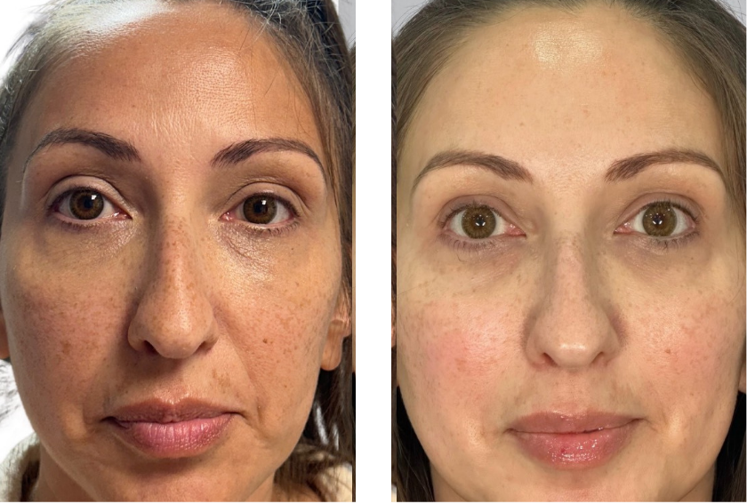 picolazer facial savage mn