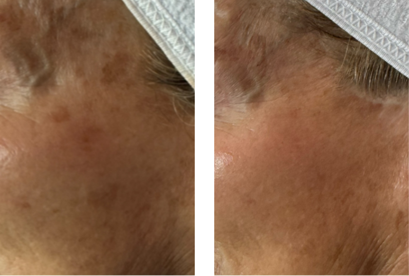 pico laser facial bloomington mn