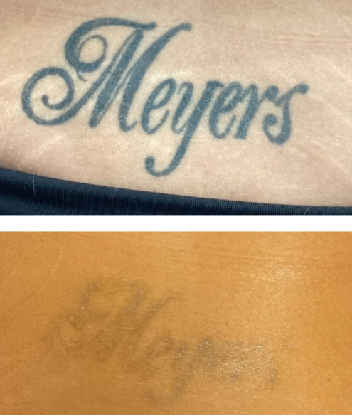 laser tattoo removal rosemount mn