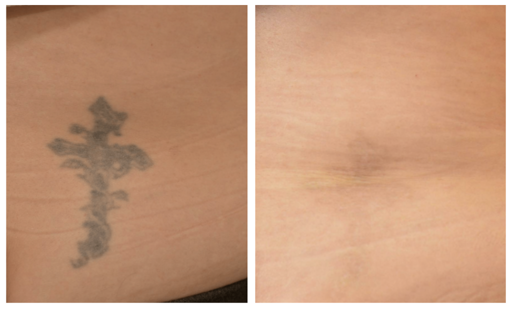 laser tattoo removal burnsville
