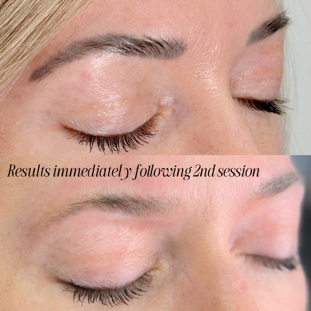 tattoo removal lakeville mn