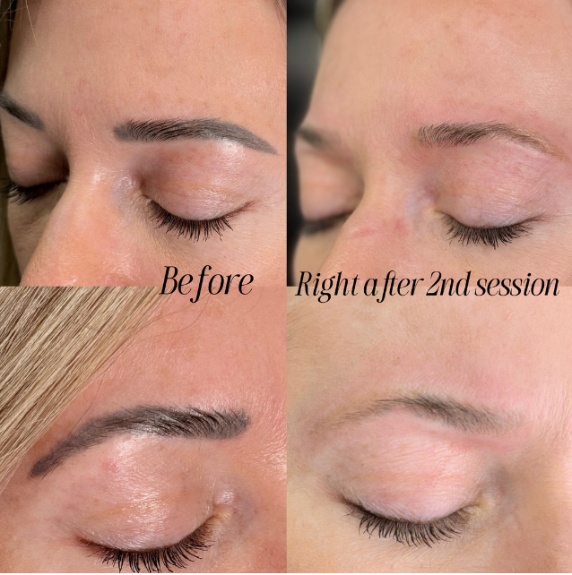 laser tattoo removal rosemount mn