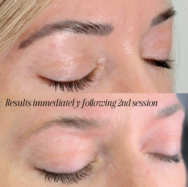 laser tattoo removal permanent makeup burnsville mn