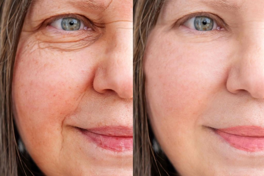 botox treatment before and after