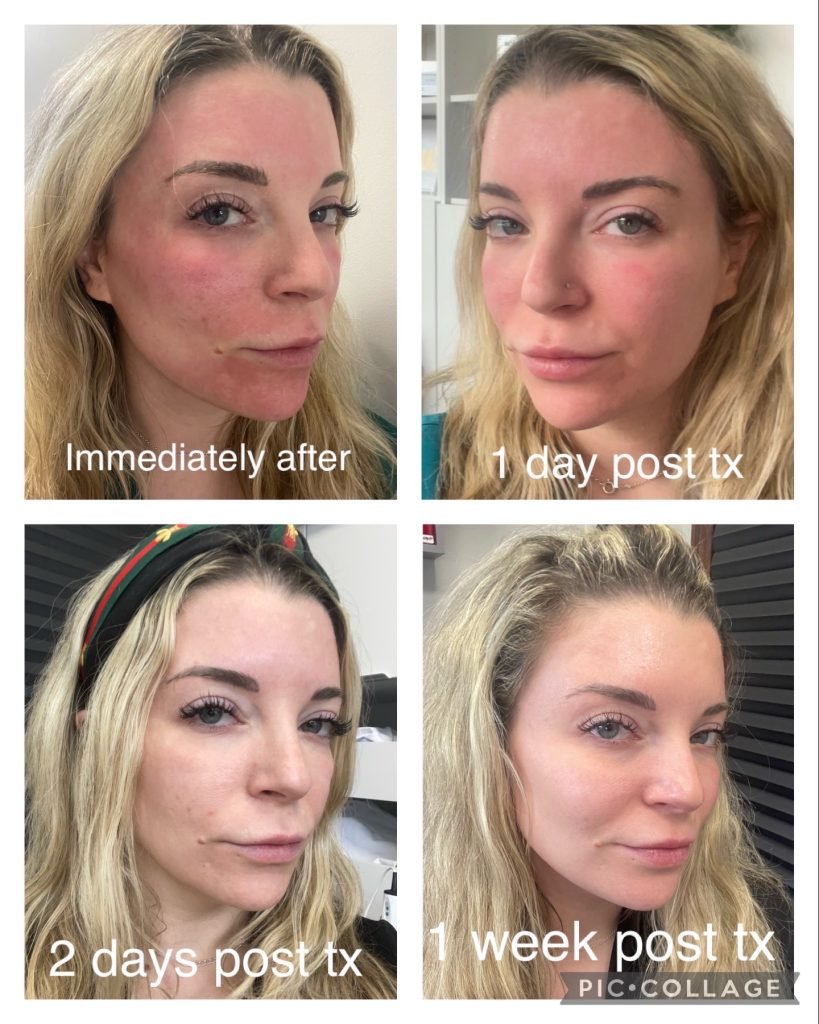 Tixel healing process